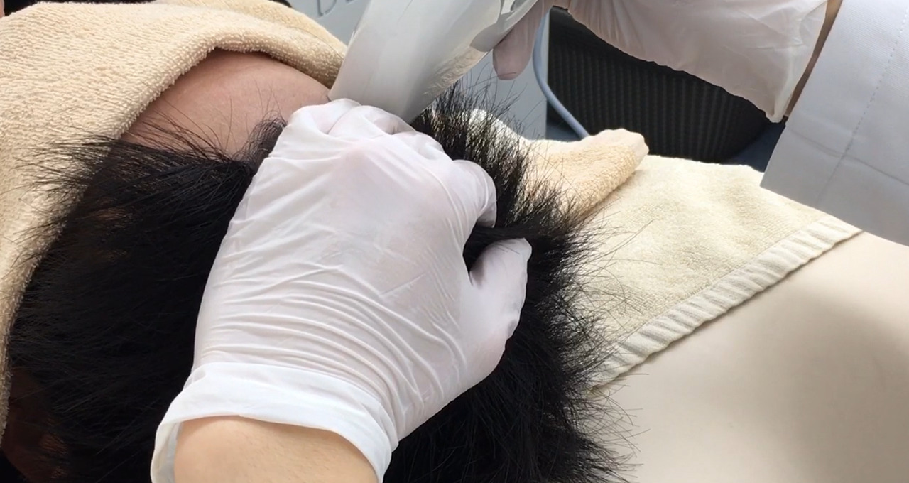 加古川の男性でAGA(男性型脱毛症)の方はいませんか?