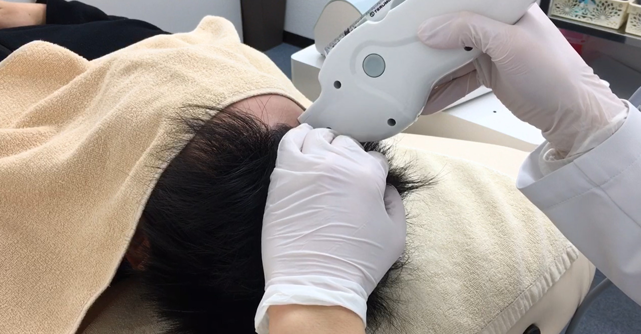 明石の女性で薄毛で悩んでいる方はいませんか?