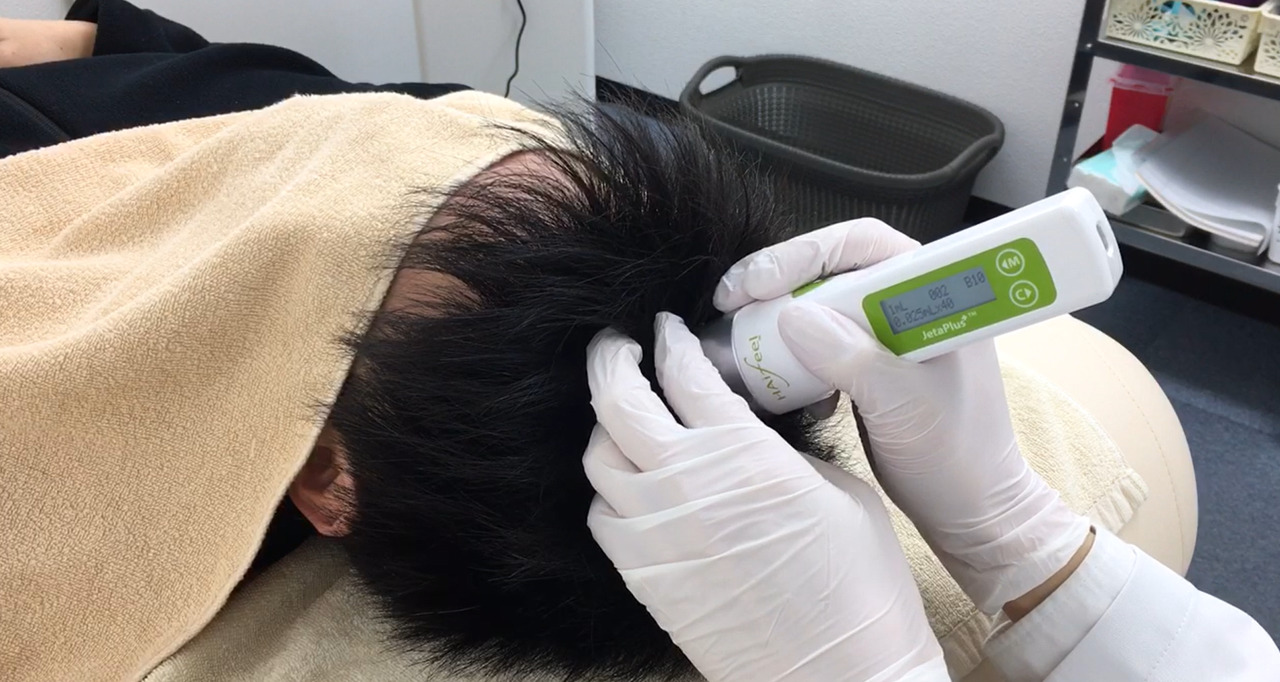 明石の男性でAGA(男性型脱毛症)の方はいませんか?